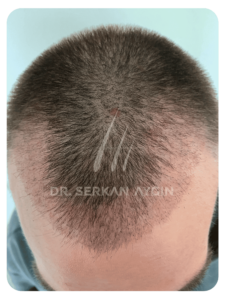 4 Wochen nach der Haartransplantation