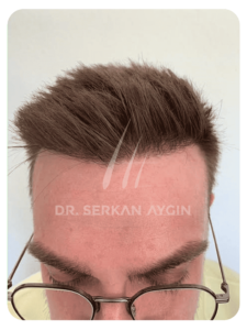 Haartransplantation nach 12 Monaten