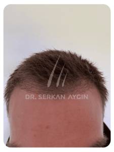 Haartransplantation nach 3 Monaten