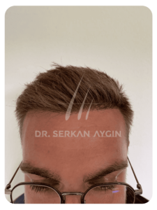Haartransplantation nach 6 Monaten