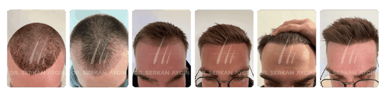 Haartransplantation wachstum vorher nachher