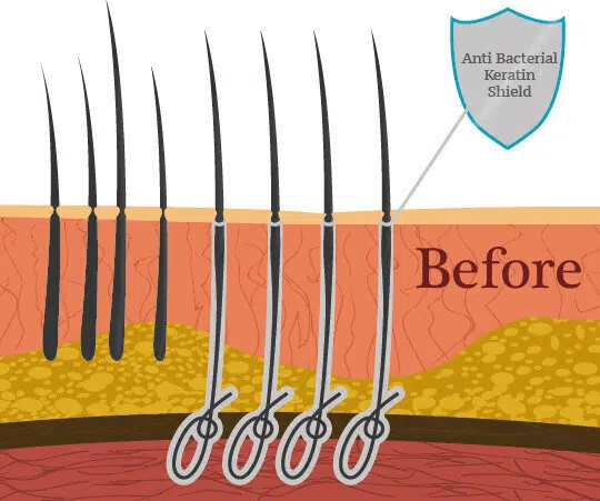 méthode de transplantation de cheveux par bio fibre avant