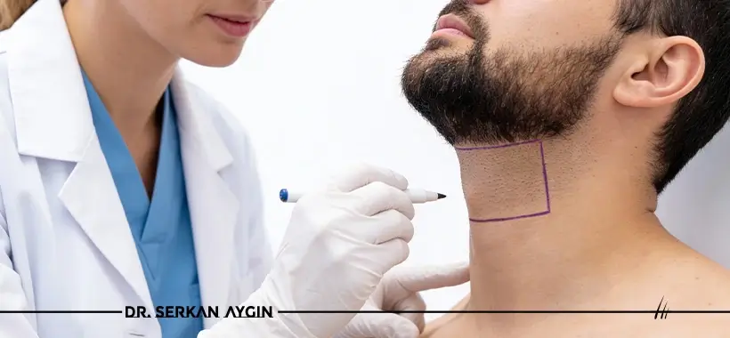 Beard to Head Hair Transplant