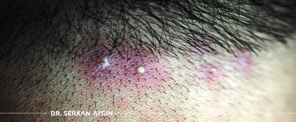 Scalp Pimples after Hair Transplantation