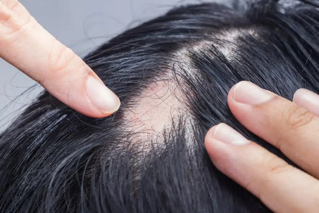 kreisrunder haarausfall durch stress
