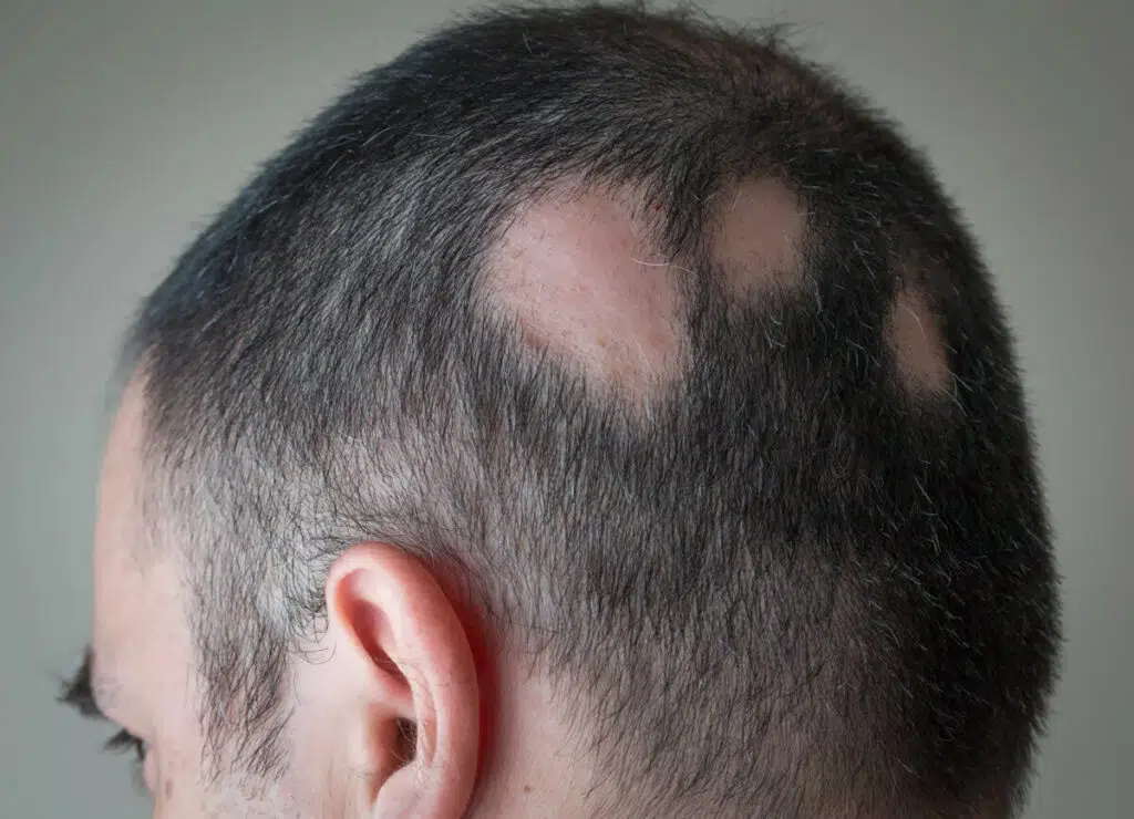 kreisrunder haarausfall stress