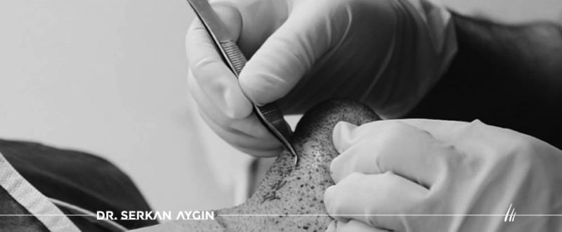 DHI baartransplantation in der Türkei