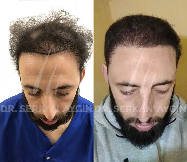 إصلاح عملية زراعة الشعر الفاشلة لمحمد في عيادة الدكتور سركان أيجين