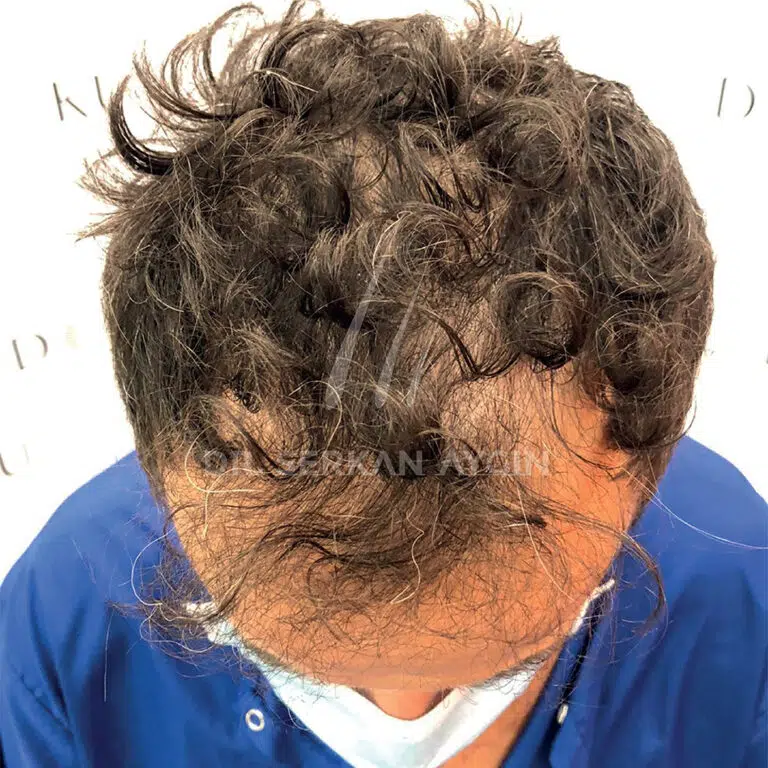 GABRIELE BOSCHI before Hair Transplant in Turkey