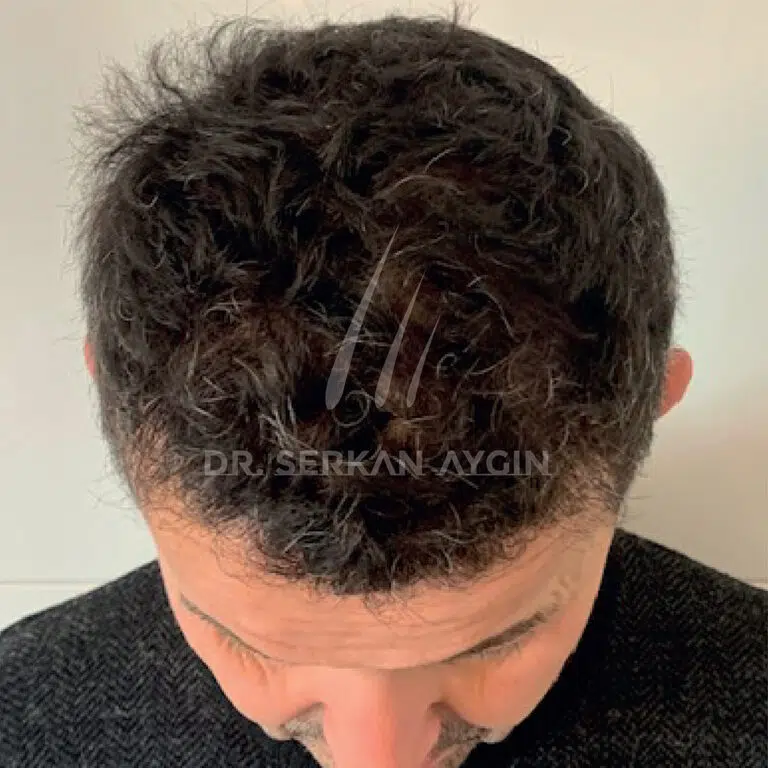 GABRIELE BOSCHI after Hair Transplant in Turkey