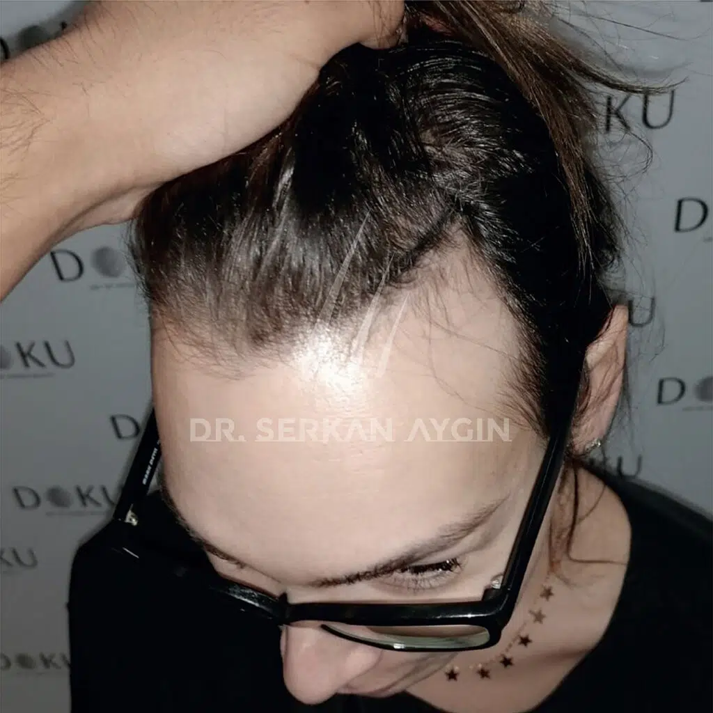 FRANCESCA LUCIANI before Hair Transplantation