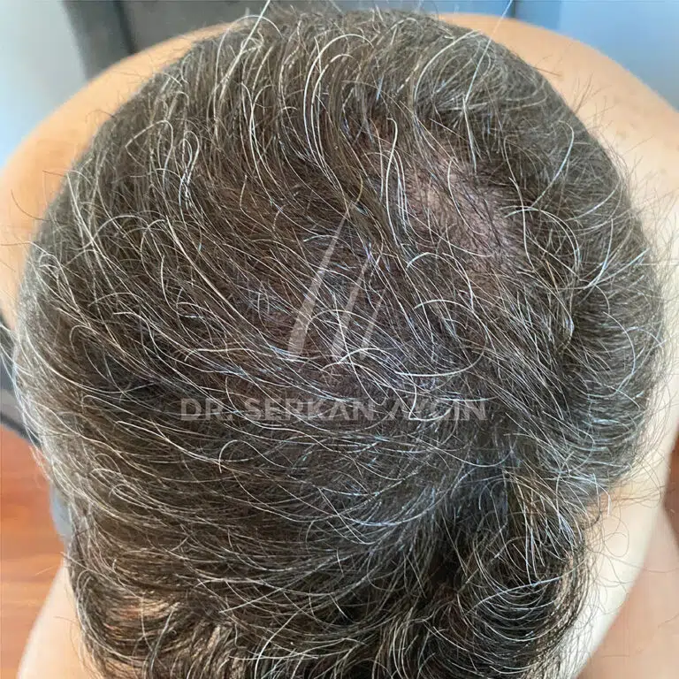 RAFFAELE GENOVESE after Hair Transplantation in Turkey