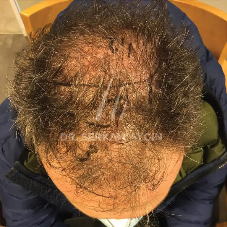 RAFFAELE GENOVESE before Hair Transplantation in Turkey
