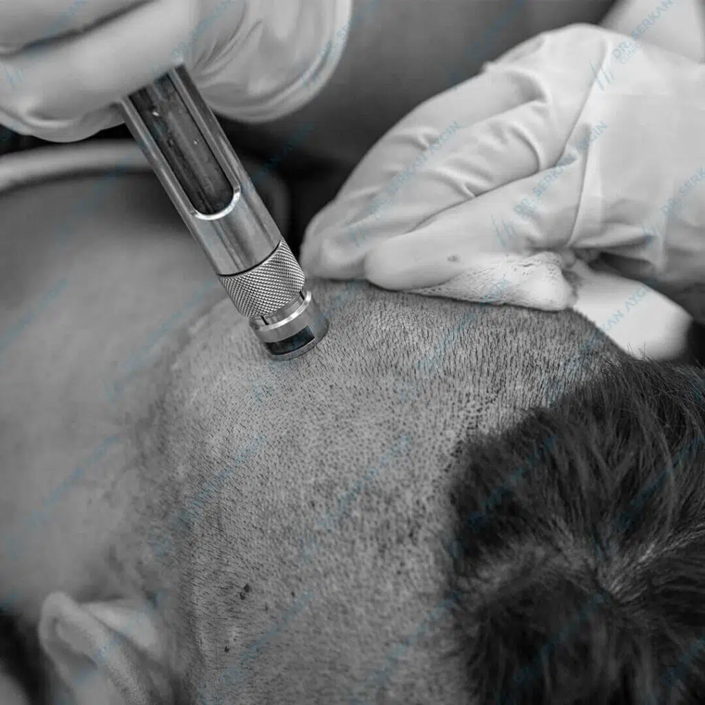 Haartransplantation Betäubung ohne nadeln