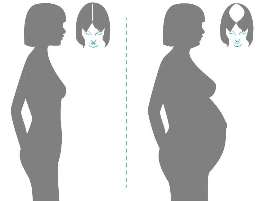 hair loss during pregnancy