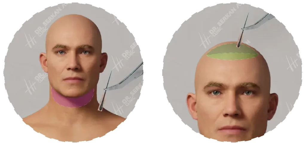 Haartransplantation vom Bart
