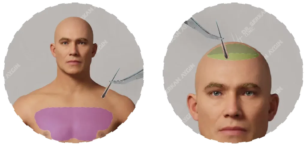 Haartransplantation mit Körperhaare