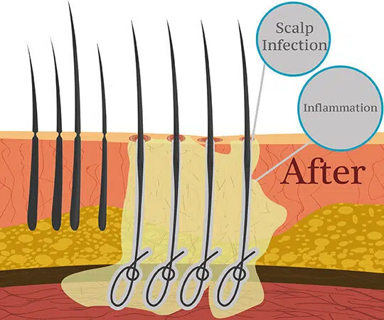 metodo di trapianto di capelli con biofibre dopo