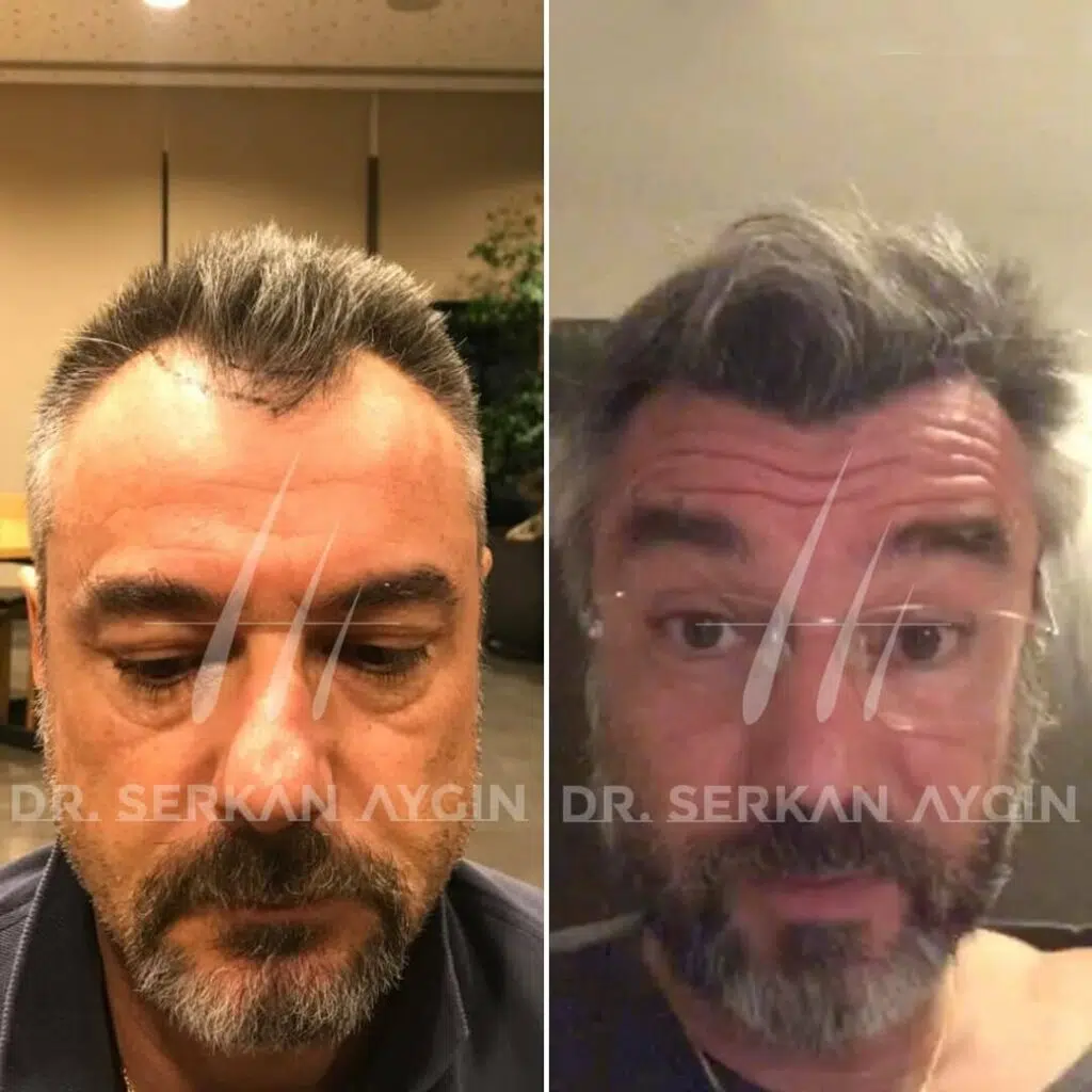 هل سيتطابق لون شعري بعد زراعة الشعر