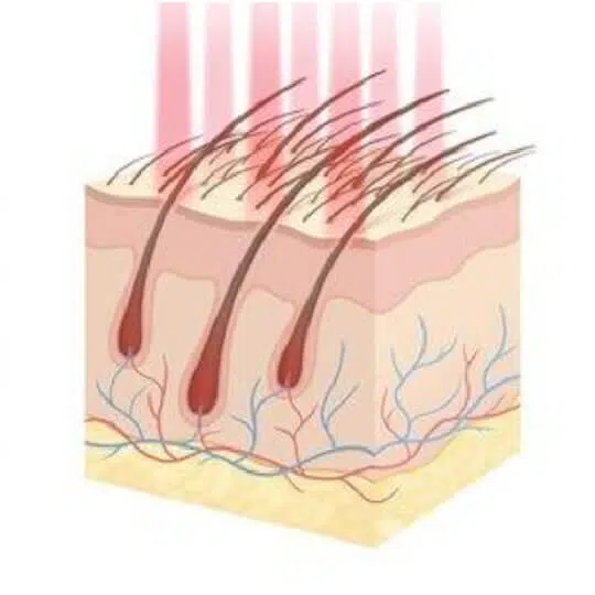 Hair follicle with laser