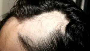 Alopecia areata