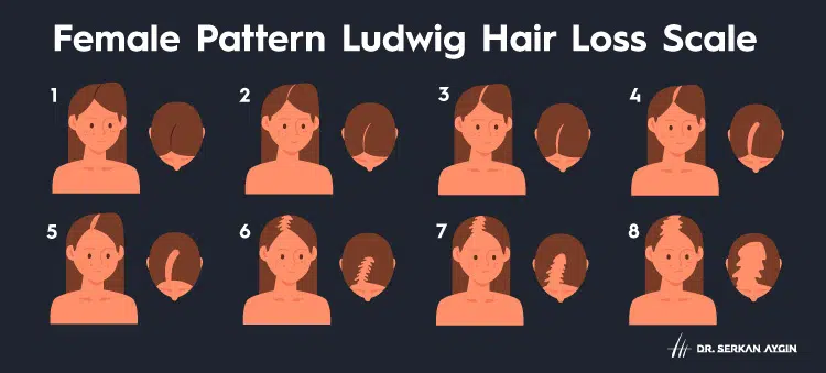 Female pattern Ludwig hair loss scale