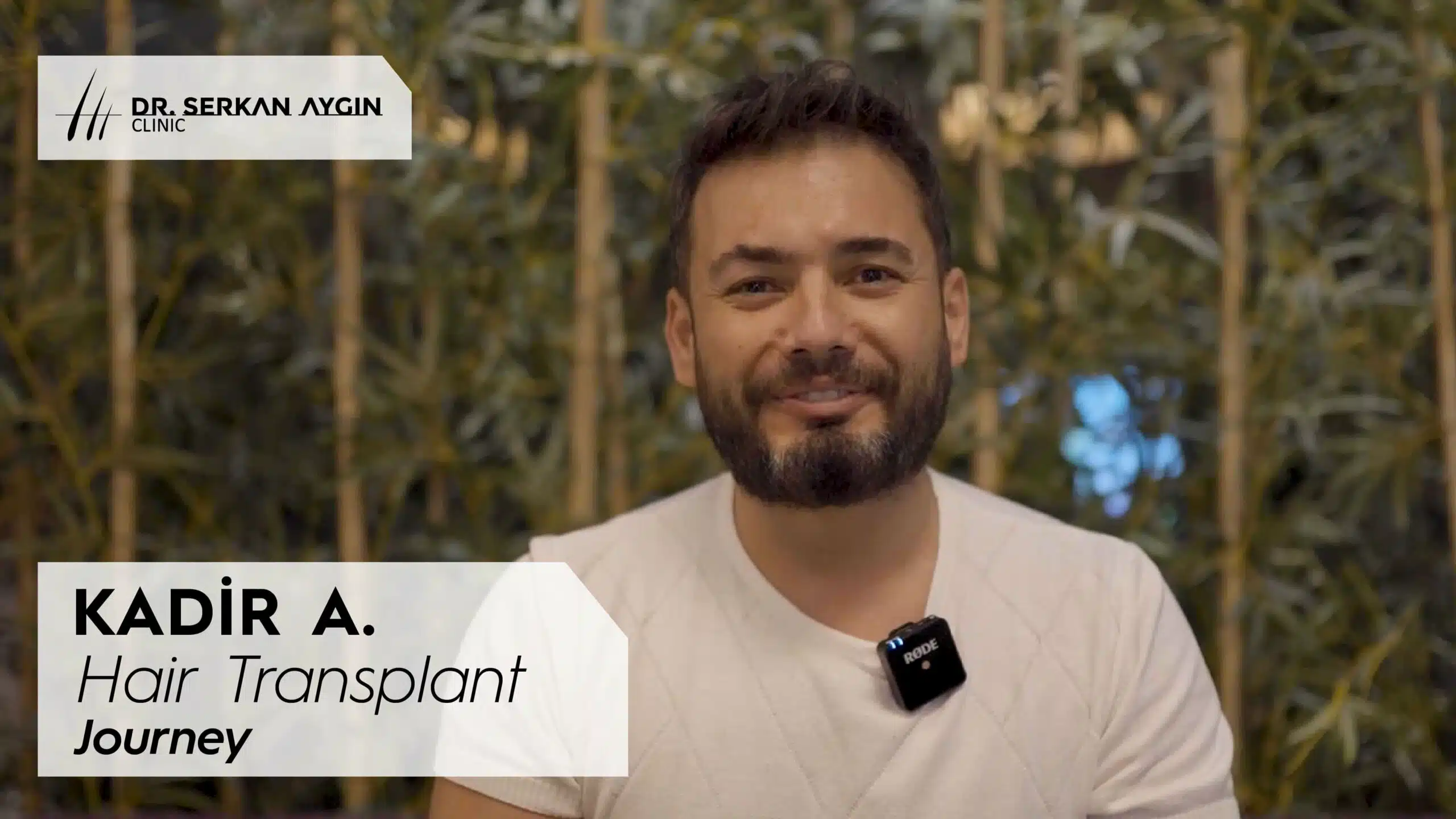 kadiralkan hair transplant experience