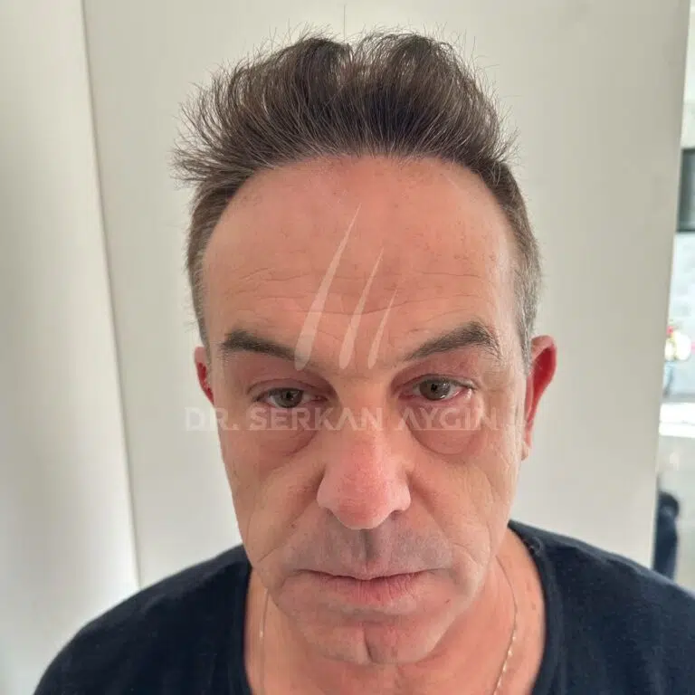 4200 grafts Result after 12 months