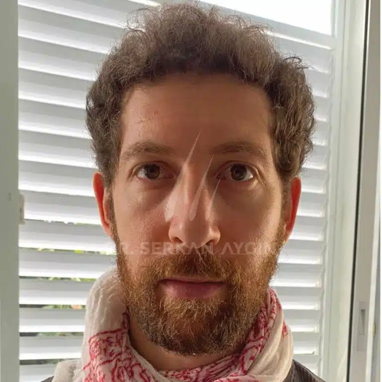 ADAM BRUTTMAN After Hair Transplant in Turkey