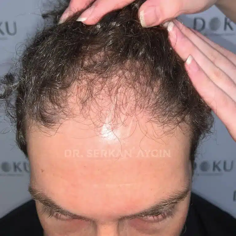 ADAM BRUTTMAN Before Hair Transplant in Turkey