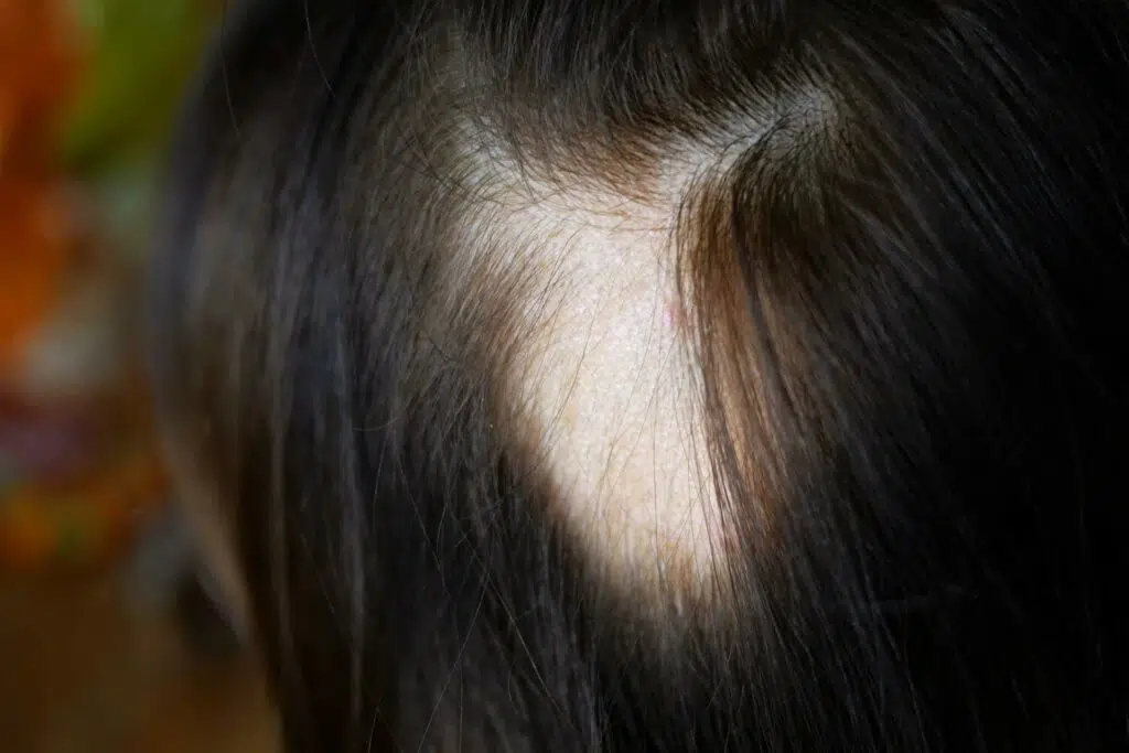 Alopecia areata