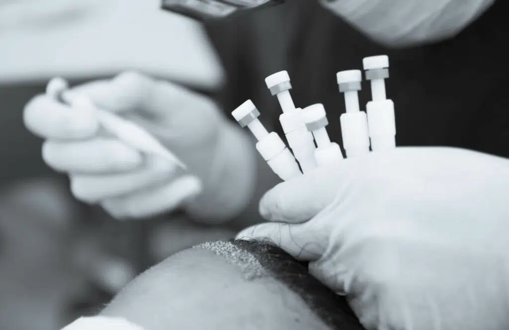 DHI Hair Transplant – Cost, Max Density & 12-Month Results (DHI vs FUE) | Dr. Serkan Aygin