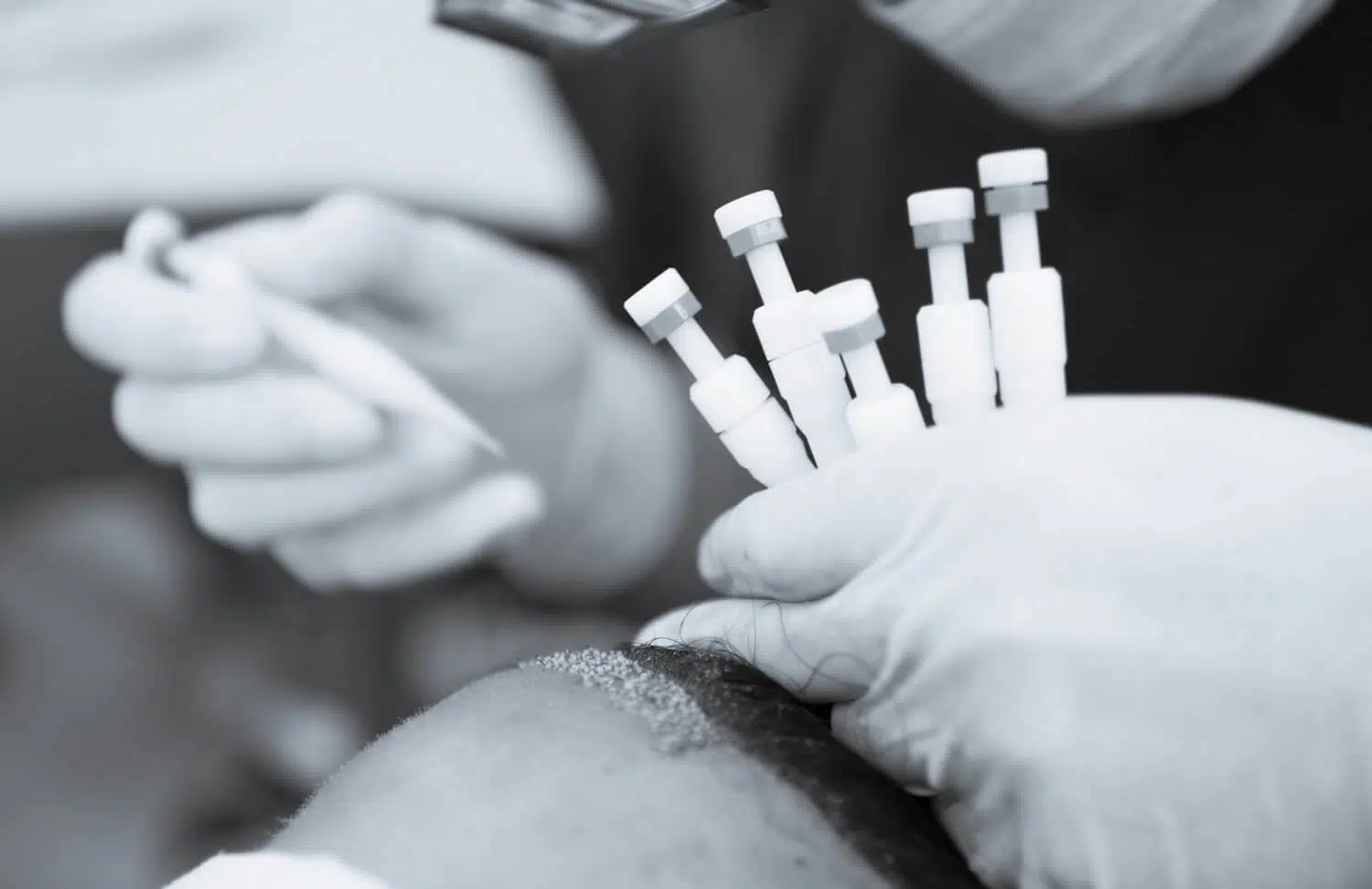 DHI Hair transplant