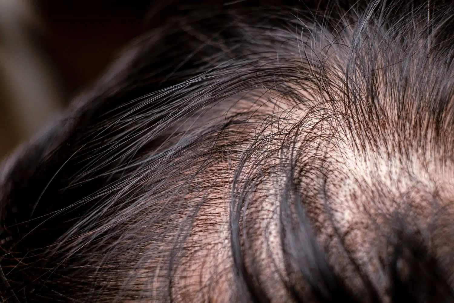 Diffuse Thinning Hair transplant