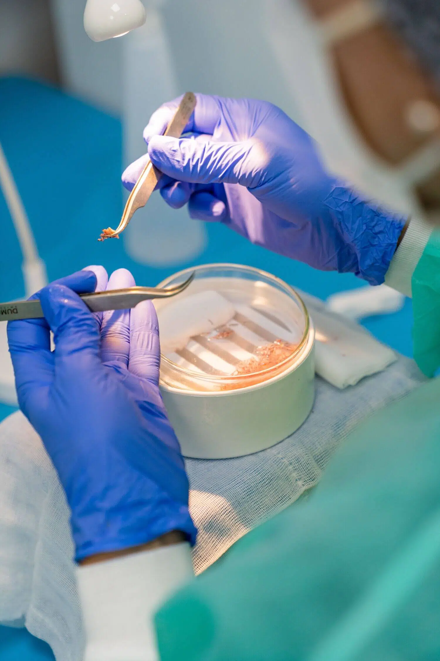 FUE Hair transplant