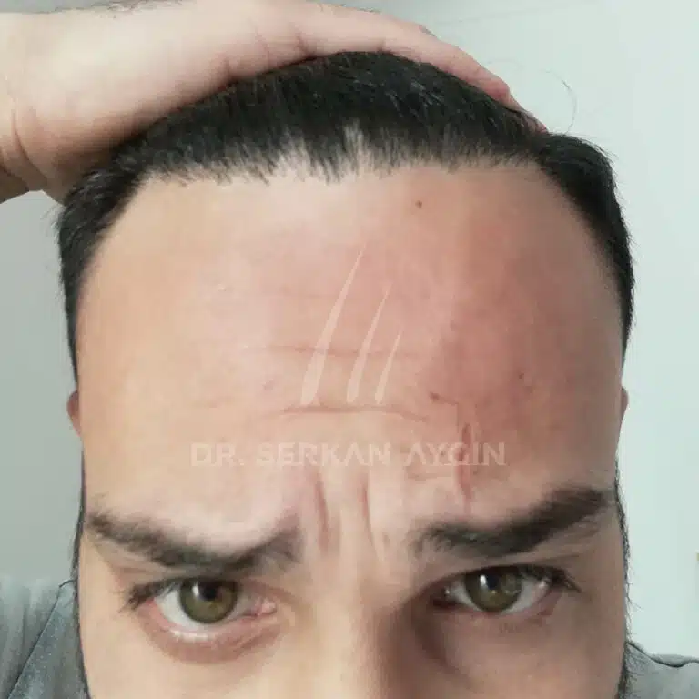 FUE hair transplant - 12 months after result