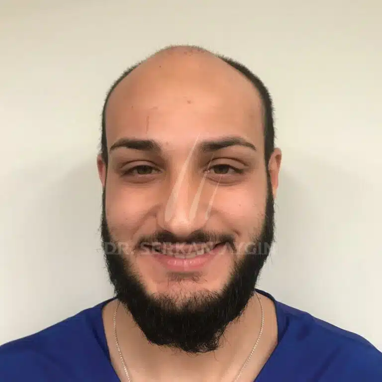 FUE hair transplant - 12 months before