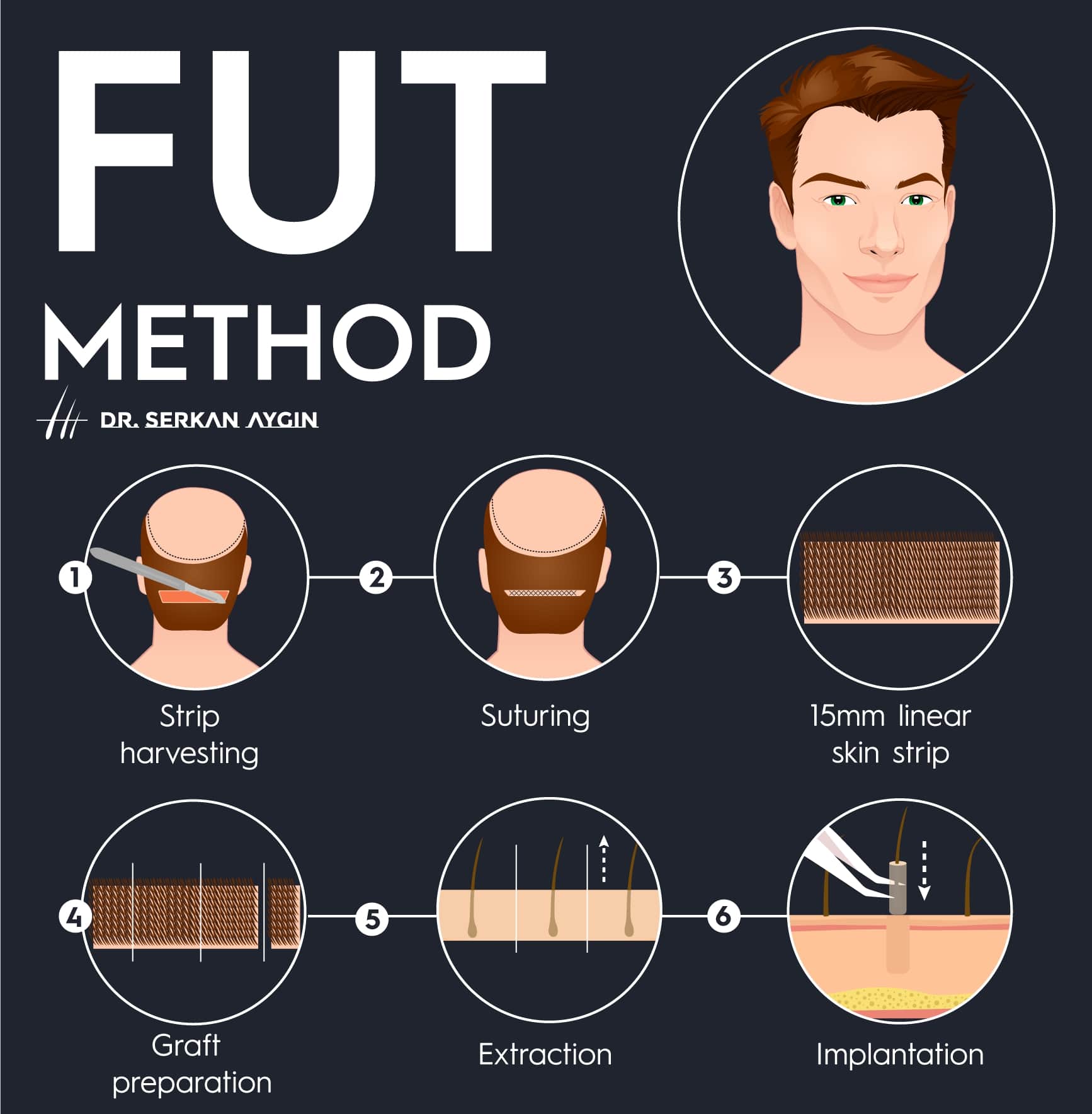 FUT-method