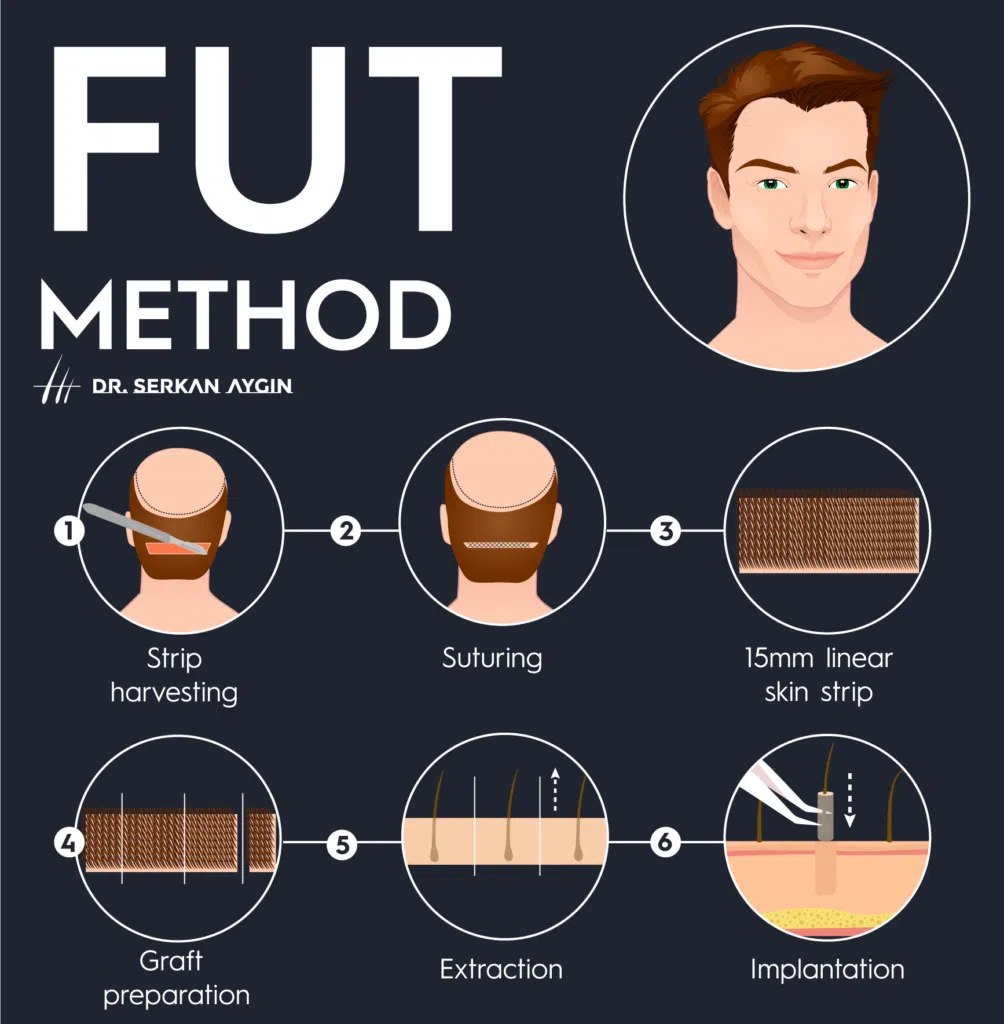 FUT hair transplant, fut procedure, fut hair restoration, dr serkan aygin