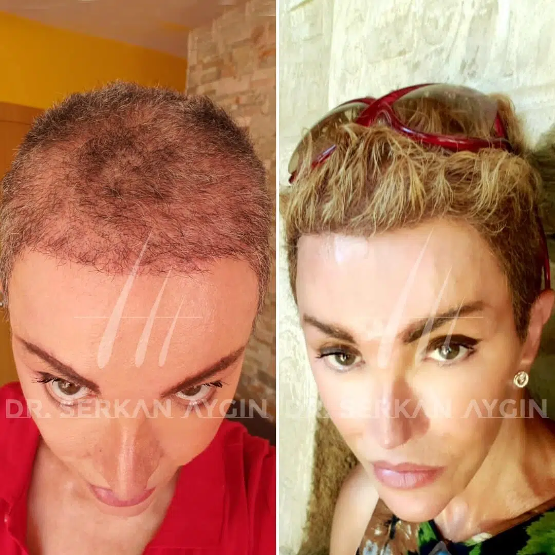 Haartransplantation vorher nachher Frauen