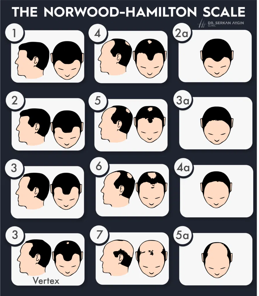 hair loss scale, norwood-hamilton scale, man hair loss stages, male hair loss scale