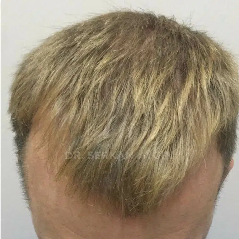 Hair transplant Turkey comparison 3300 grafts