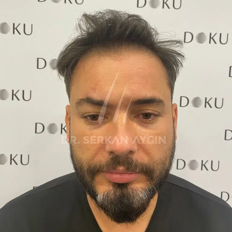 Hair transplant before after 2400 grafts