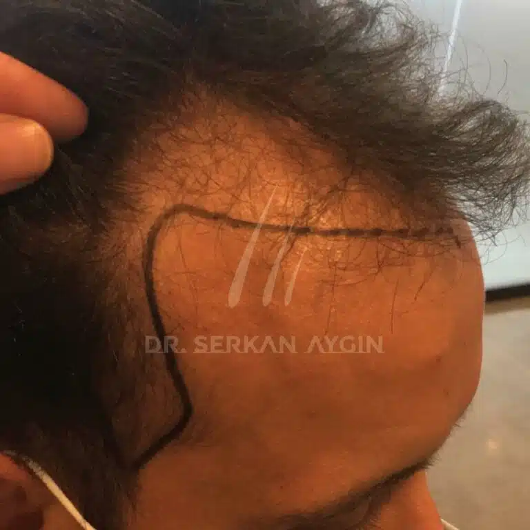 Hair transplant before after 4100 grafts