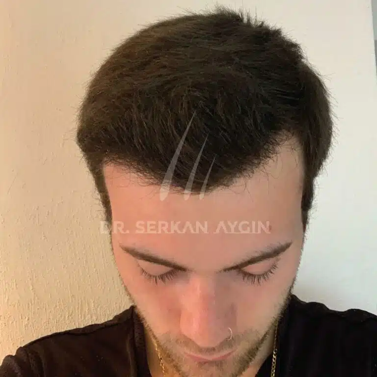 Hair transplant before and after - 3200 grafts