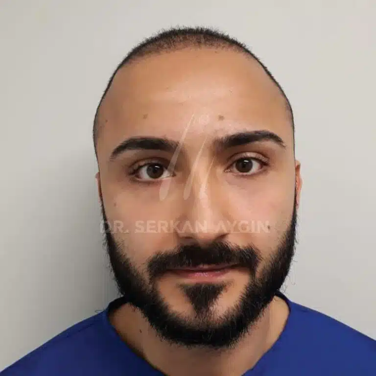 Hair transplant before and after - 3600 grafts