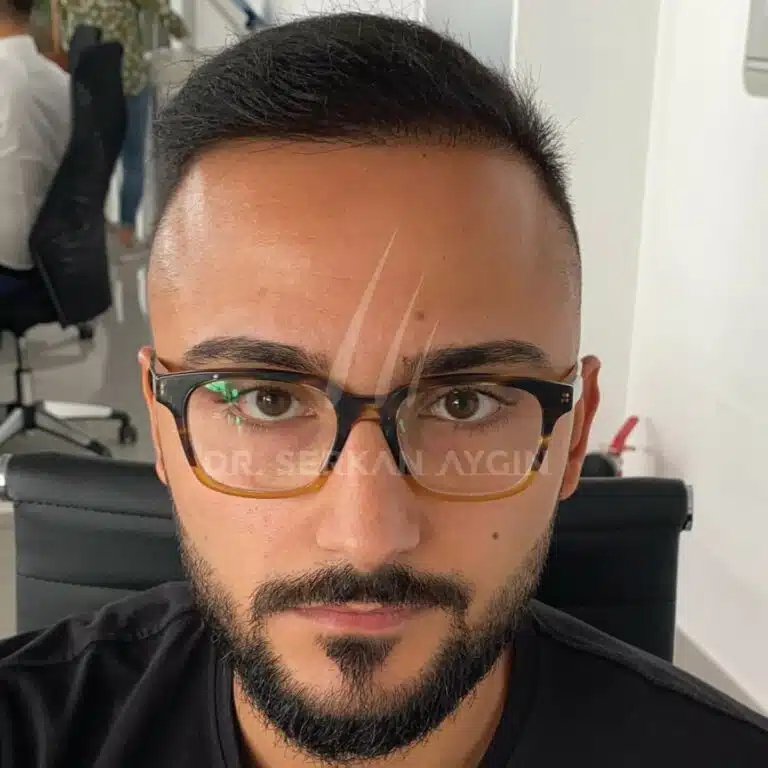 Hair transplant before and after - 3600 grafts ergebnis