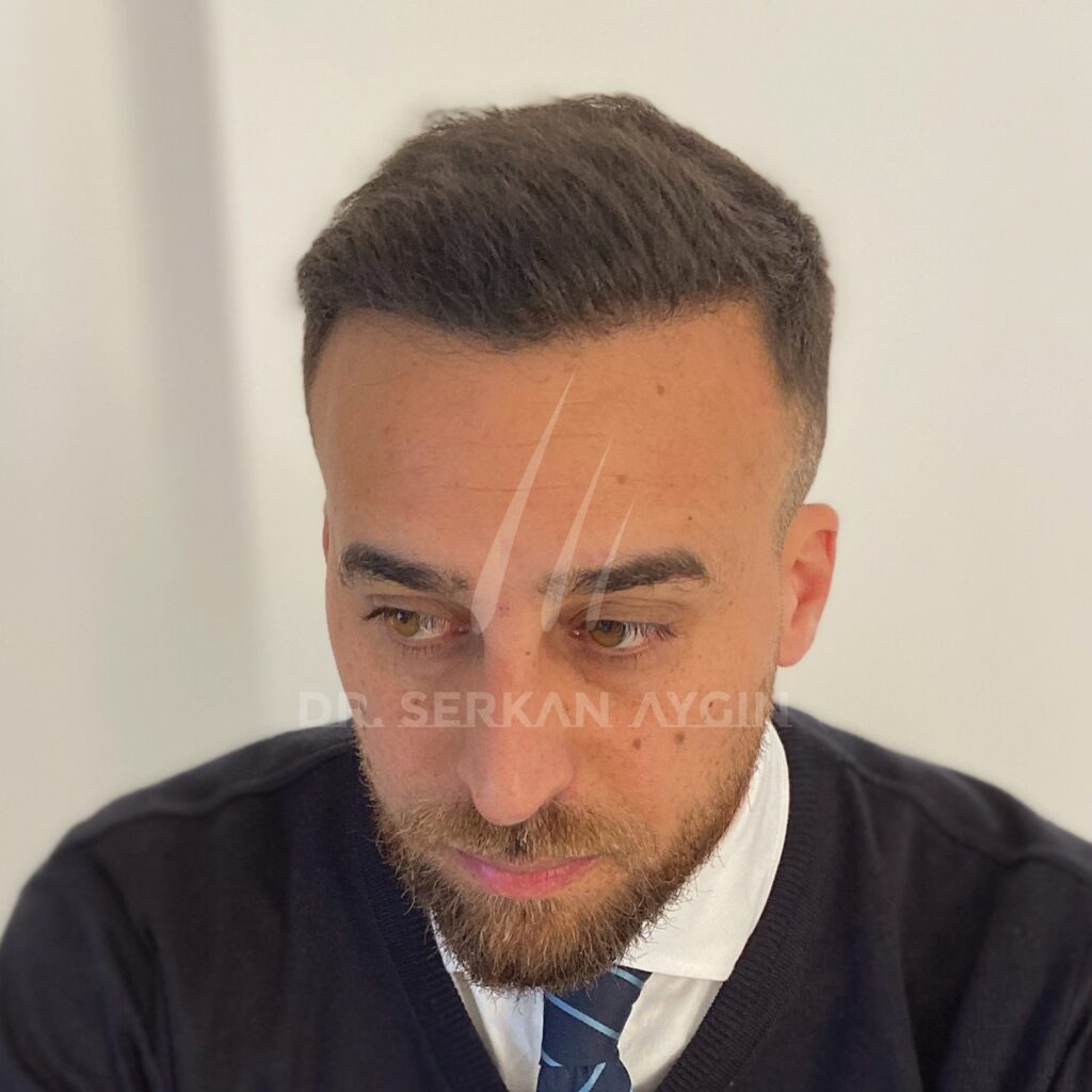 How Does Hair Growth Look Like After Transplant In Turkey