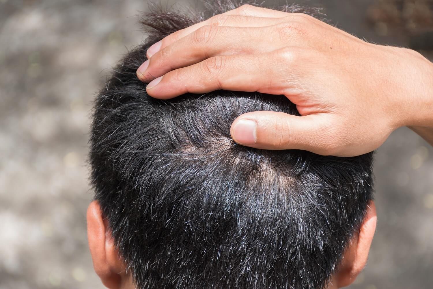 Hair transplant donor area