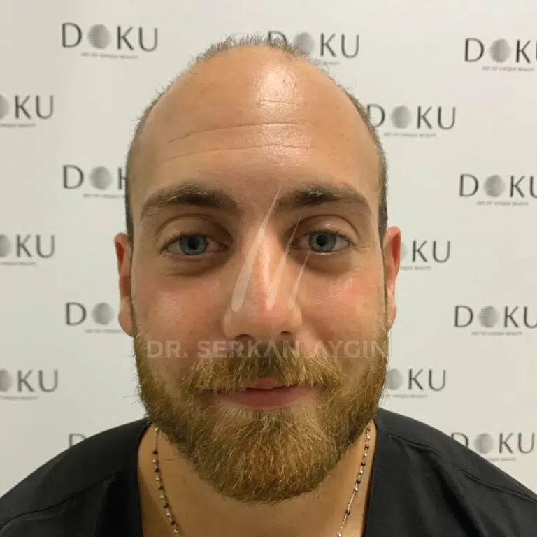 Hair transplant result_ Before and after